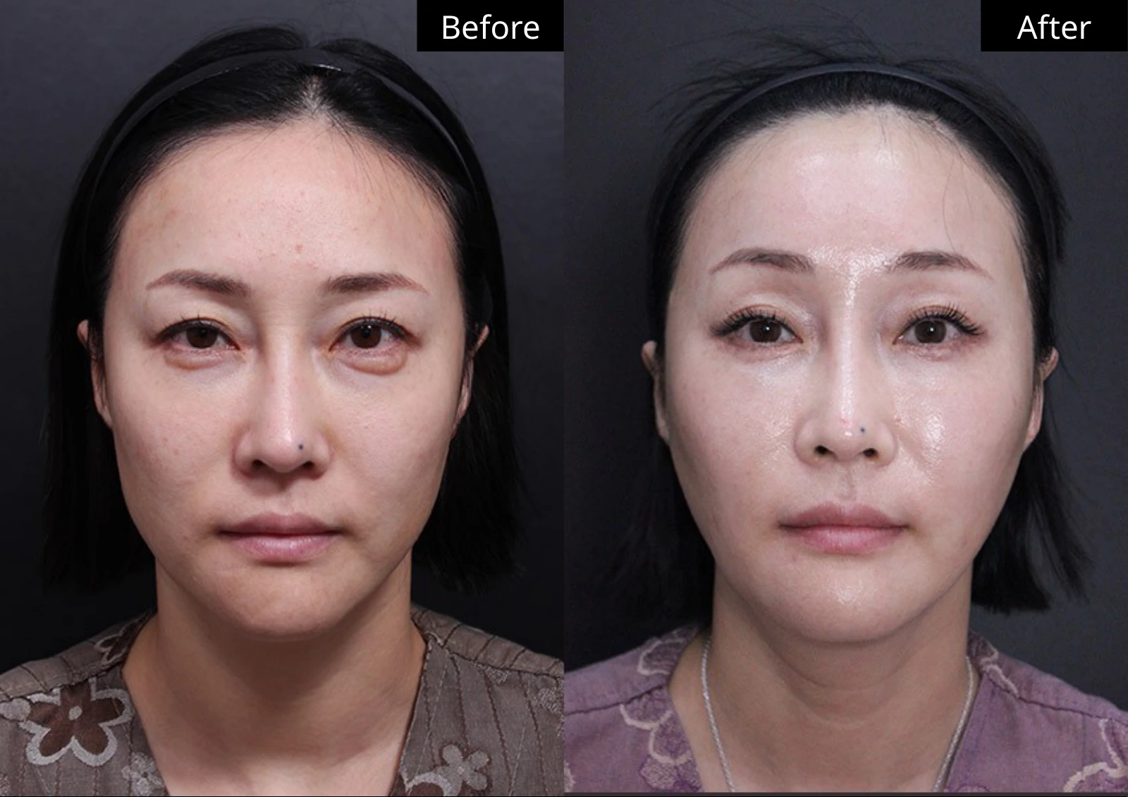 Verygood Plastic Surgery: Facial fat grafting — front view · 07. Before on the left; after on the right.