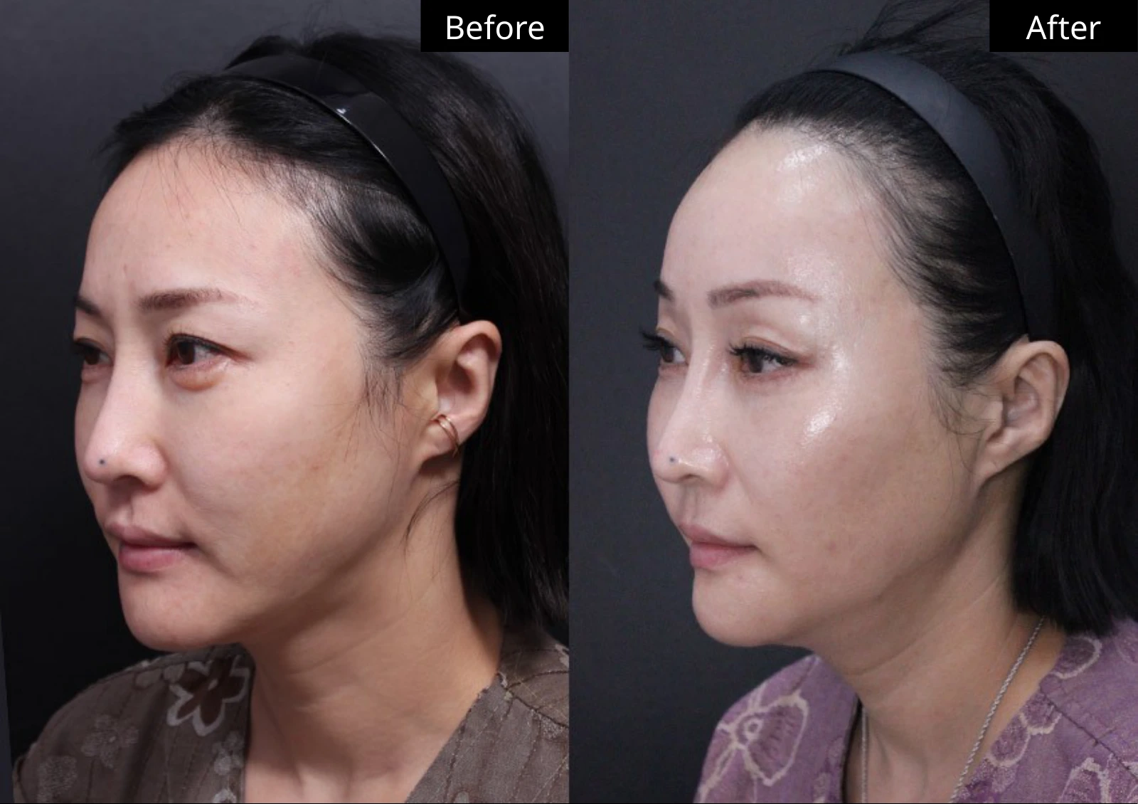 Verygood Plastic Surgery: Facial fat grafting — angled view · 08. Before on the left; after on the right.