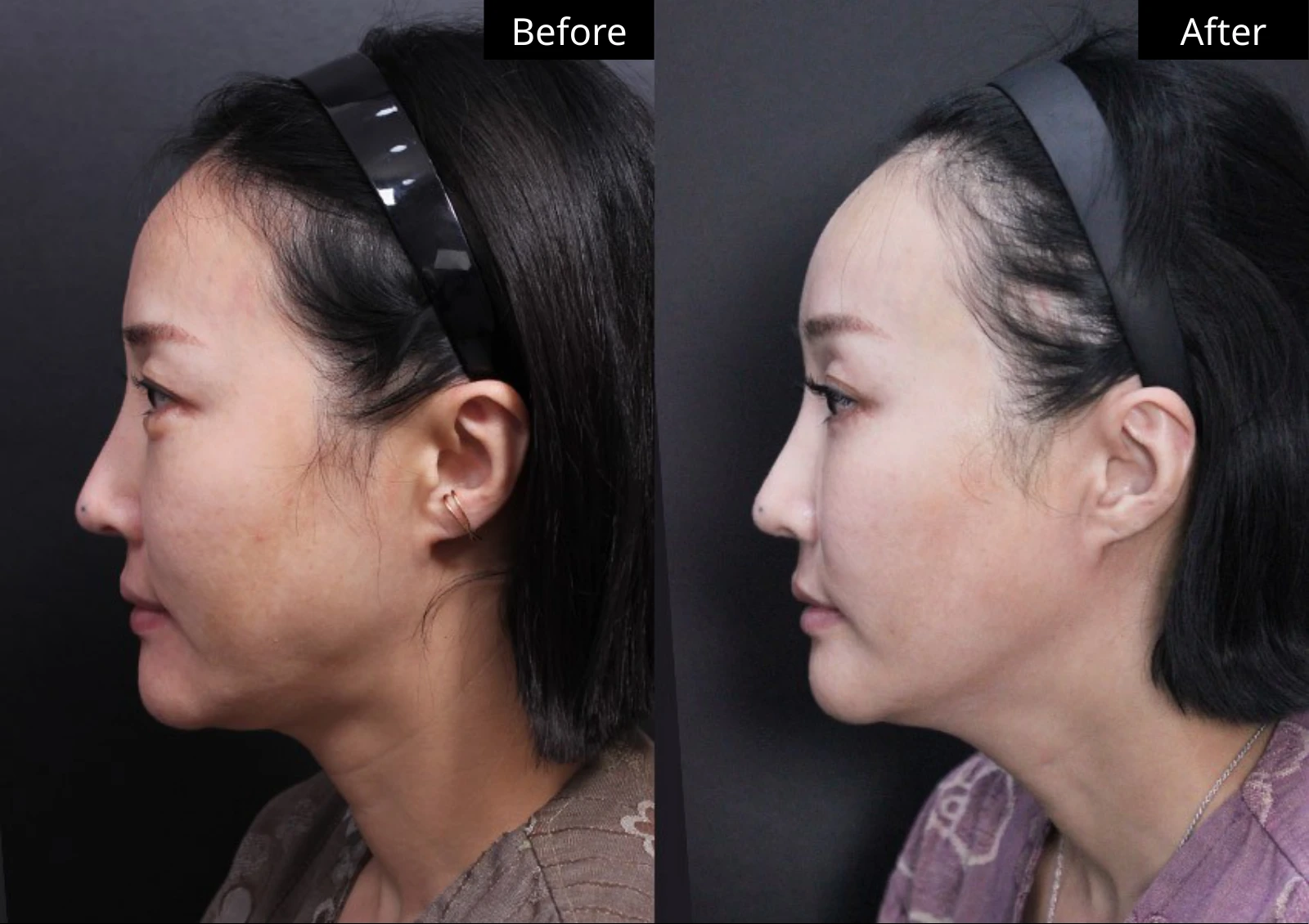 Verygood Plastic Surgery: Facial fat grafting — side profile · 09. Before on the left; after on the right.