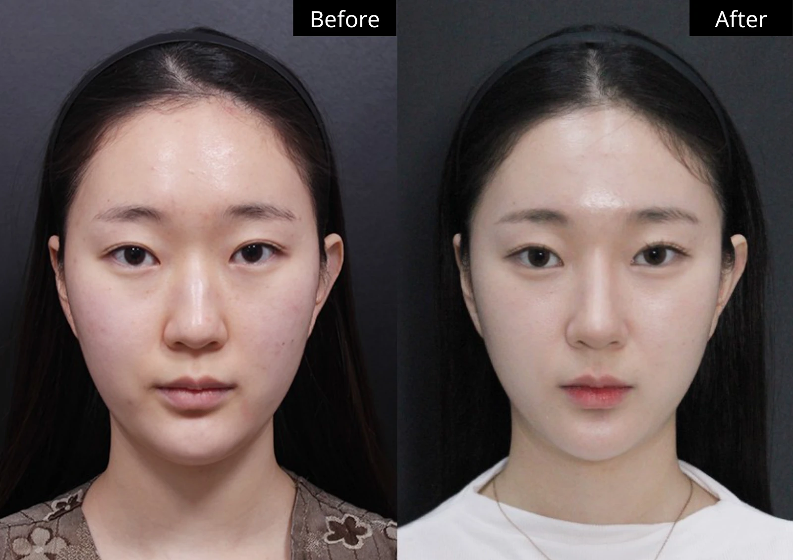 Verygood Plastic Surgery: Facial liposuction — front view · 01. Before on the left; after on the right.