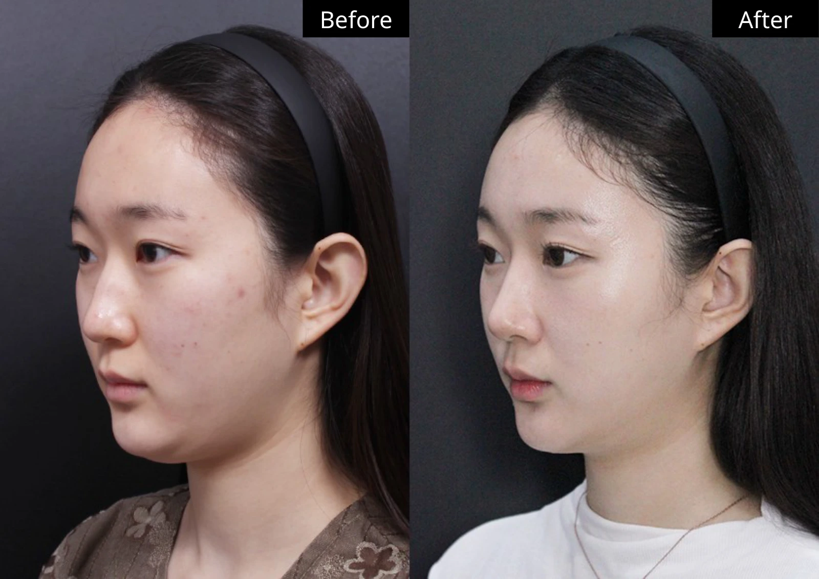 Verygood Plastic Surgery: Facial liposuction — angled view · 02. Before on the left; after on the right.
