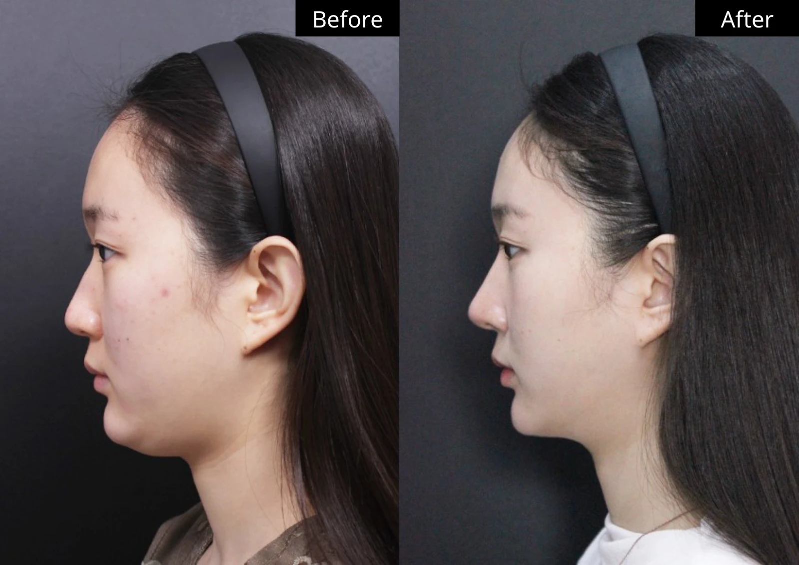 Verygood Plastic Surgery: Facial liposuction — side profile · 03. Before on the left; after on the right.