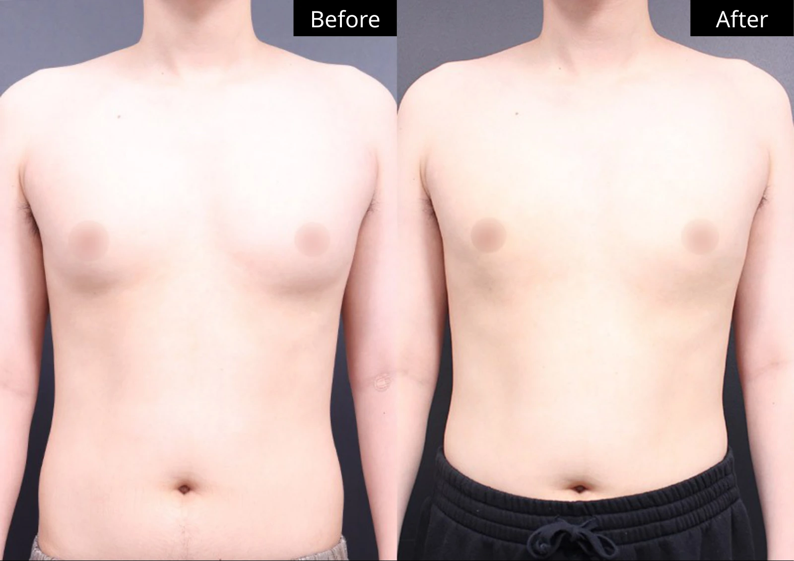Verygood Plastic Surgery: Gynecomastia surgery — front view · 01. Before on the left; after on the right.