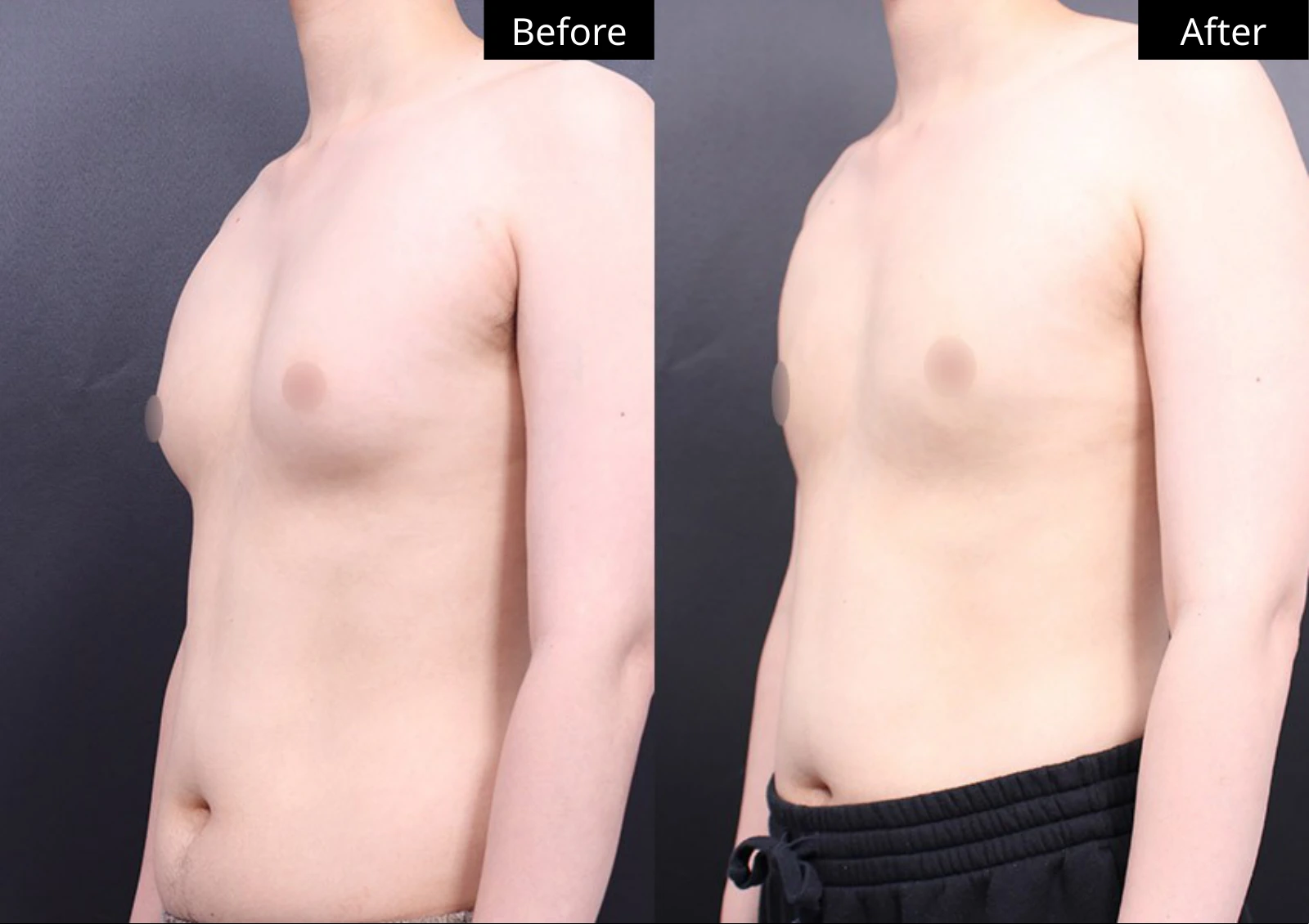 Verygood Plastic Surgery: Gynecomastia surgery — angled view · 02. Before on the left; after on the right.