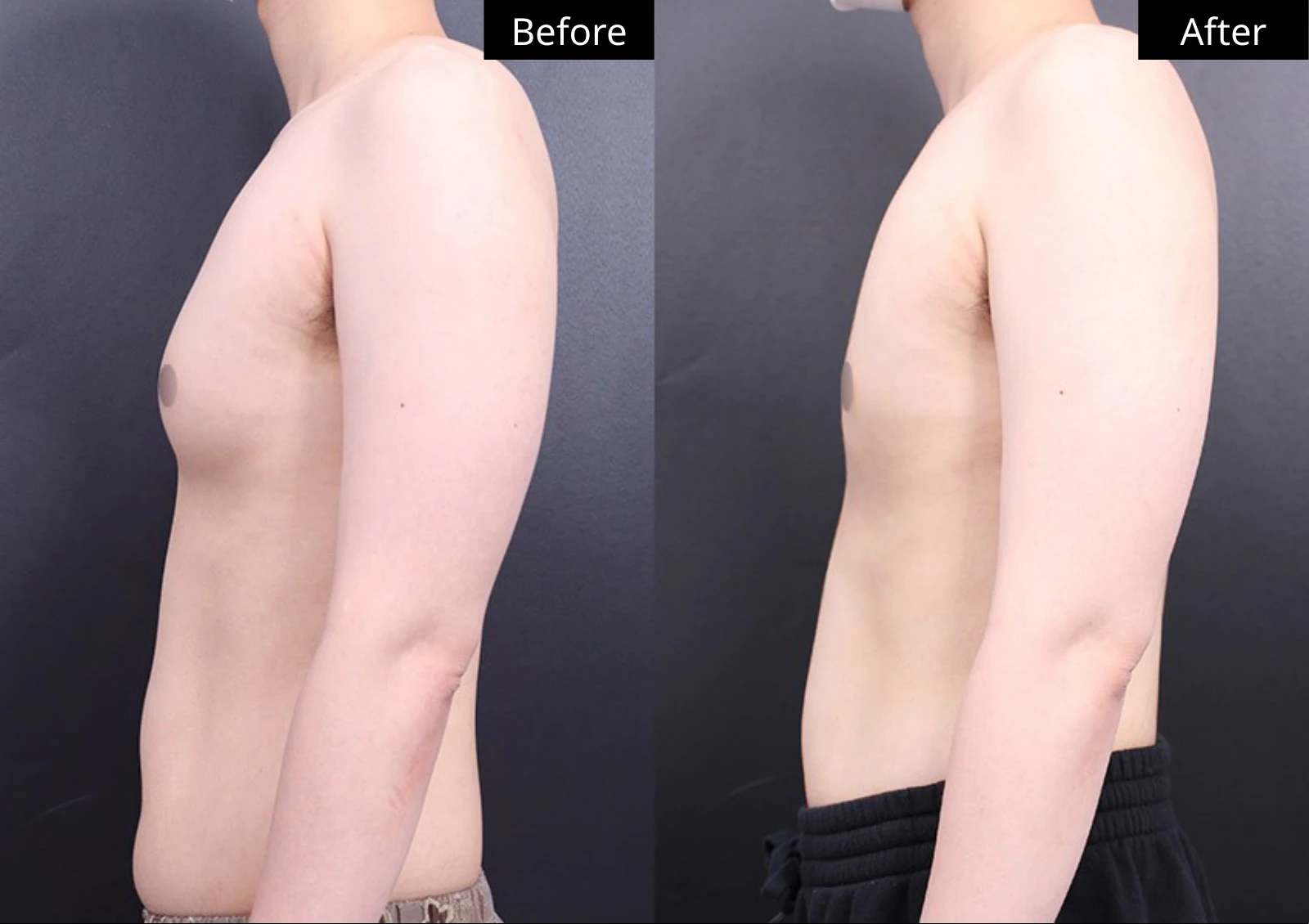 Verygood Plastic Surgery: Gynecomastia surgery — side profile · 03. Before on the left; after on the right.