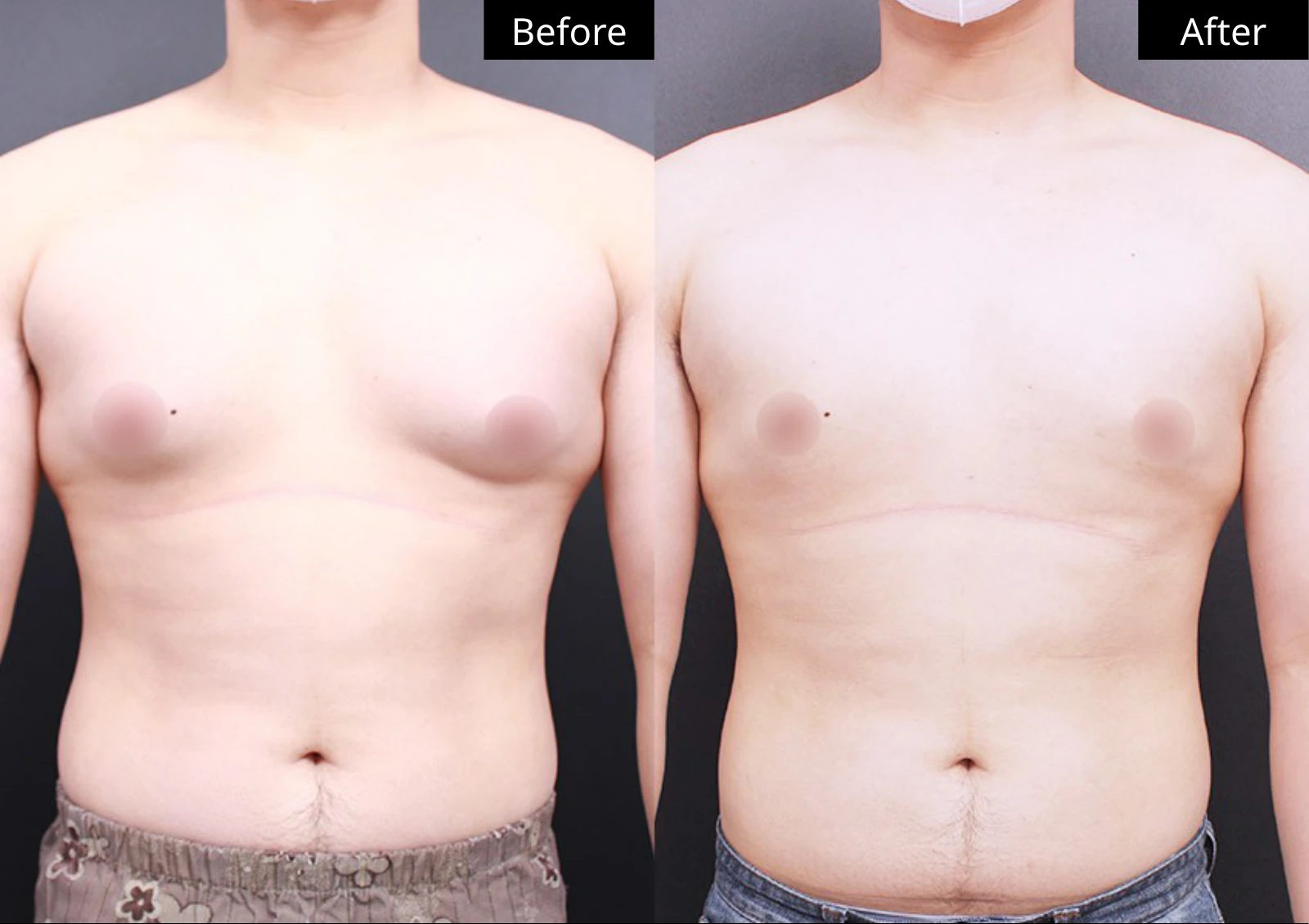Verygood Plastic Surgery: Gynecomastia surgery — front view · 04. Before on the left; after on the right.