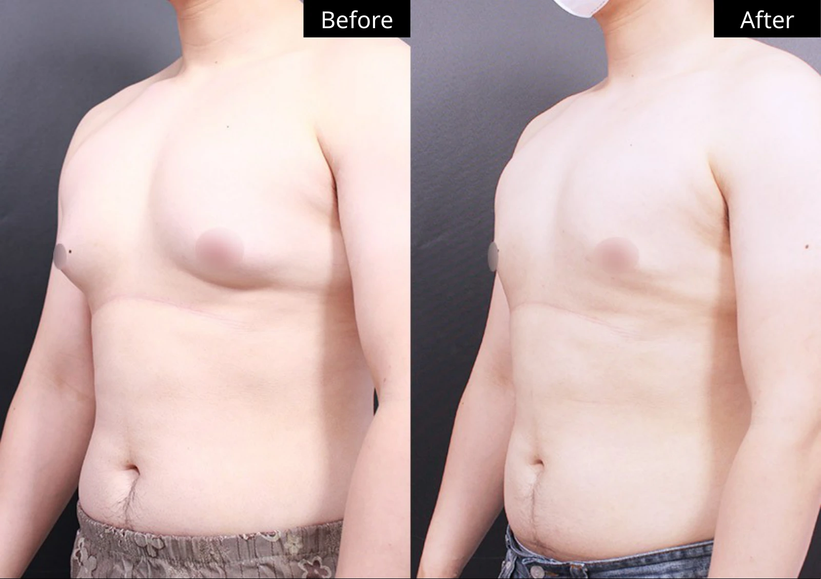 Verygood Plastic Surgery: Gynecomastia surgery — angled view · 05. Before on the left; after on the right.