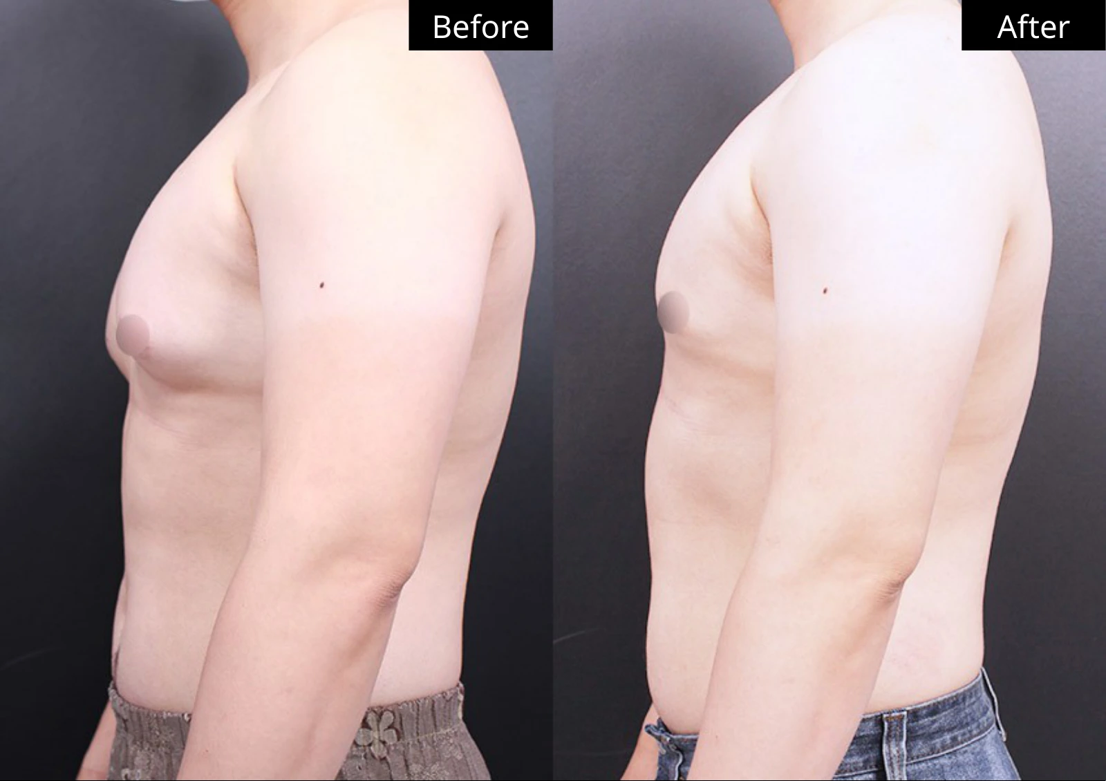 Verygood Plastic Surgery: Gynecomastia surgery — side profile · 06. Before on the left; after on the right.