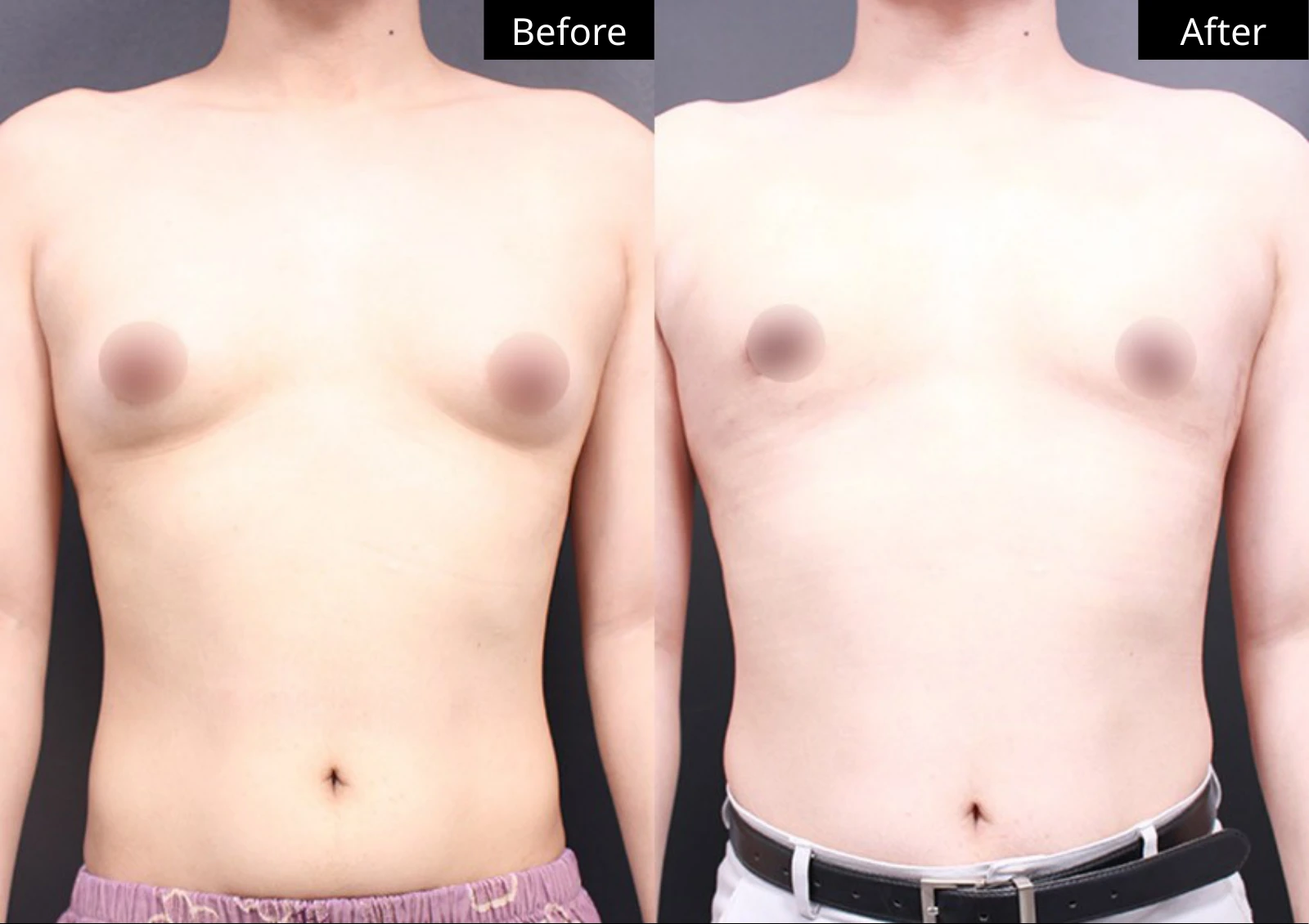 Verygood Plastic Surgery: Gynecomastia surgery — front view · 07. Before on the left; after on the right.