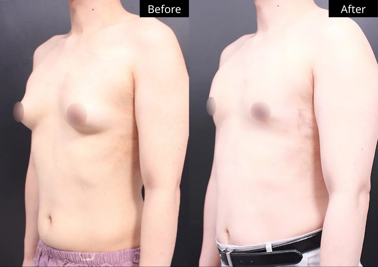 Verygood Plastic Surgery: Gynecomastia surgery — angled view · 08. Before on the left; after on the right.