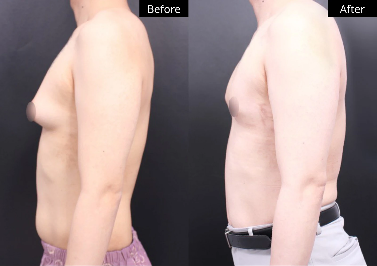 Verygood Plastic Surgery: Gynecomastia surgery — side profile · 09. Before on the left; after on the right.