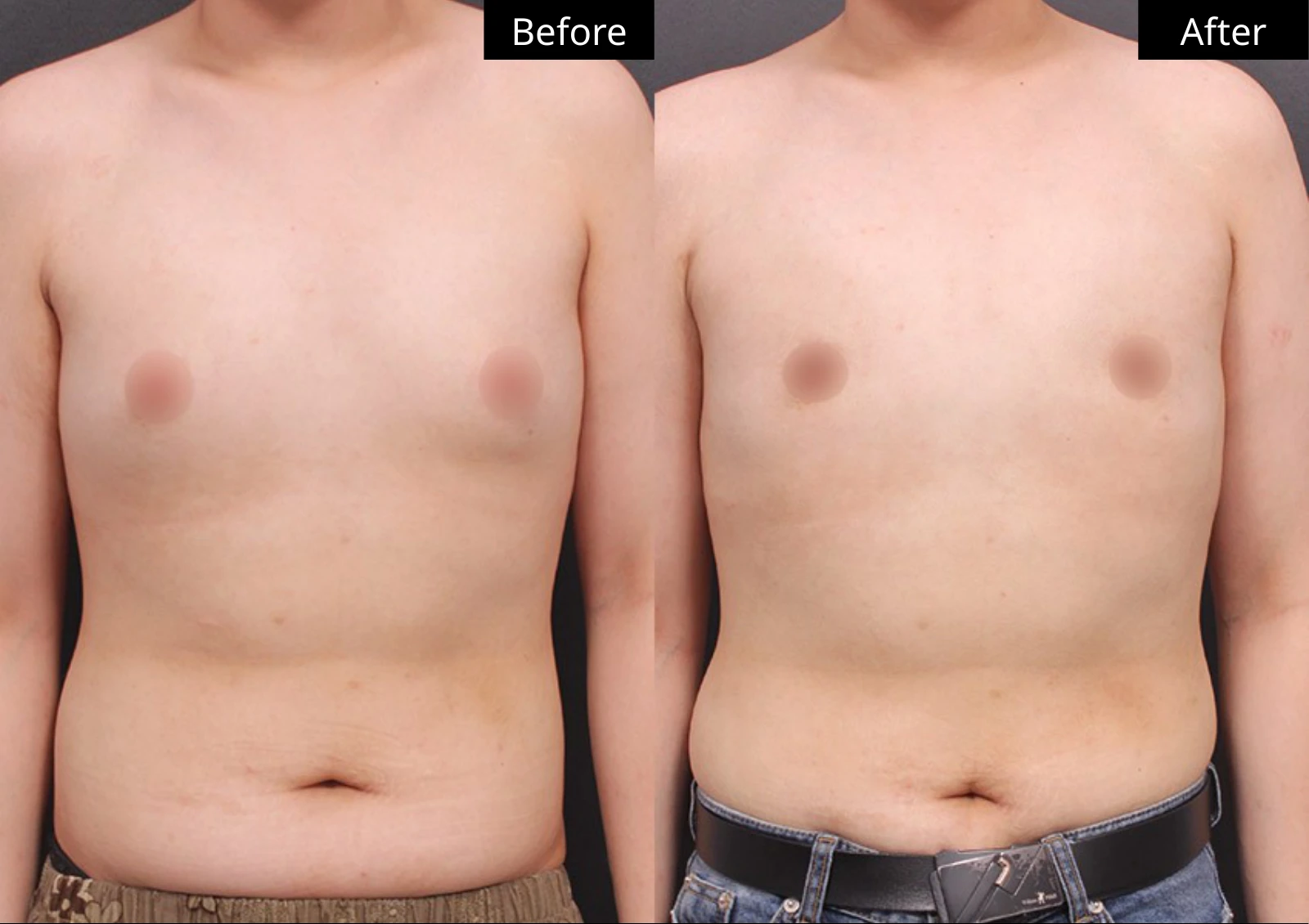 Verygood Plastic Surgery: Gynecomastia surgery — front view · 10. Before on the left; after on the right.