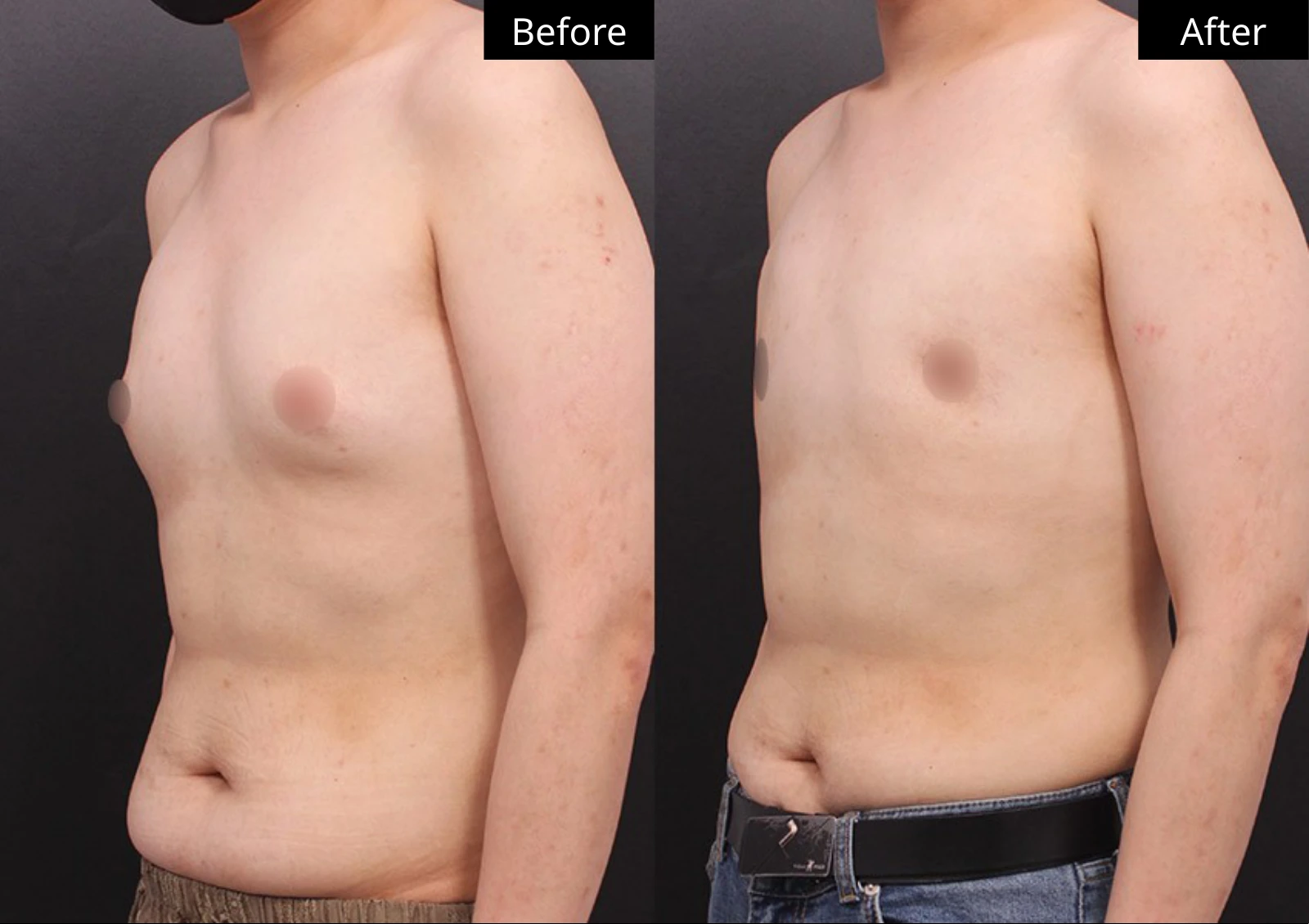 Verygood Plastic Surgery: Gynecomastia surgery — angled view · 11. Before on the left; after on the right.