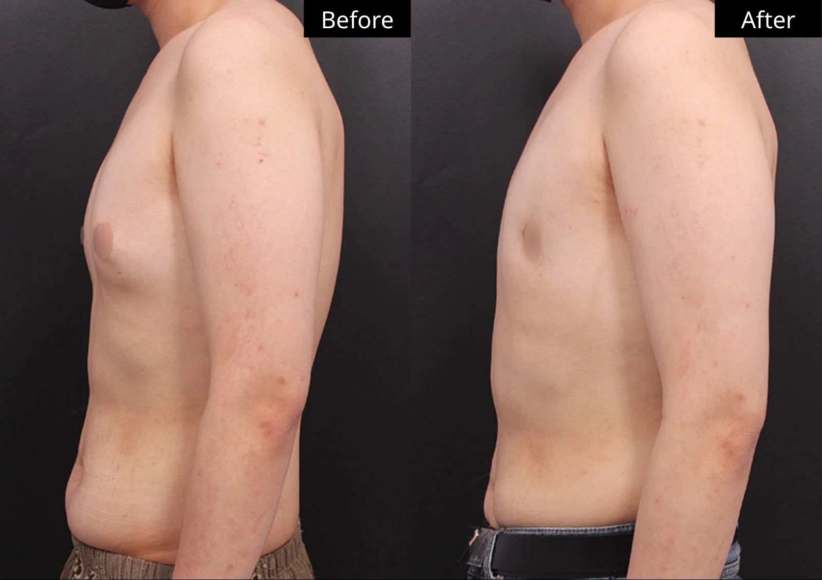 Verygood Plastic Surgery: Gynecomastia surgery — side profile · 12. Before on the left; after on the right.