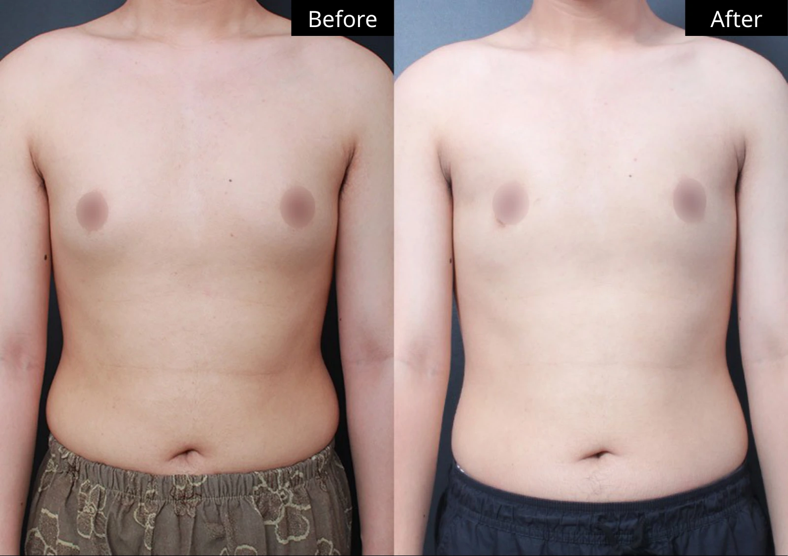 Verygood Plastic Surgery: Gynecomastia surgery — front view · 13. Before on the left; after on the right.