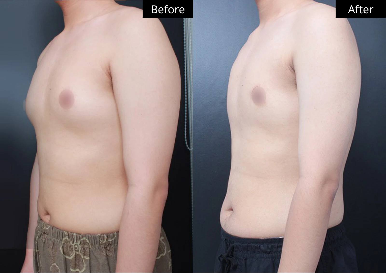 Verygood Plastic Surgery: Gynecomastia surgery — angled view · 14. Before on the left; after on the right.