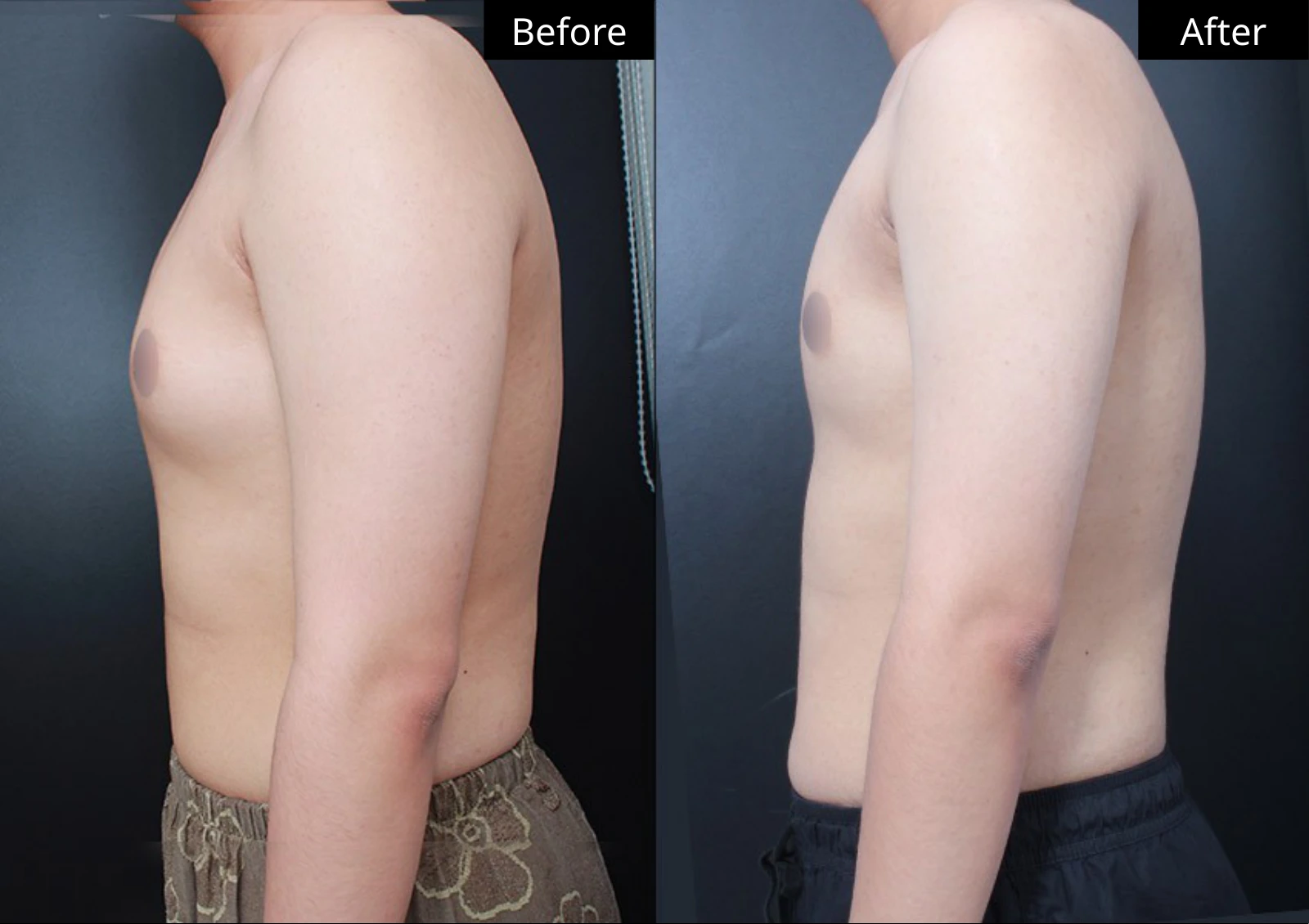 Verygood Plastic Surgery: Gynecomastia surgery — side profile · 15. Before on the left; after on the right.