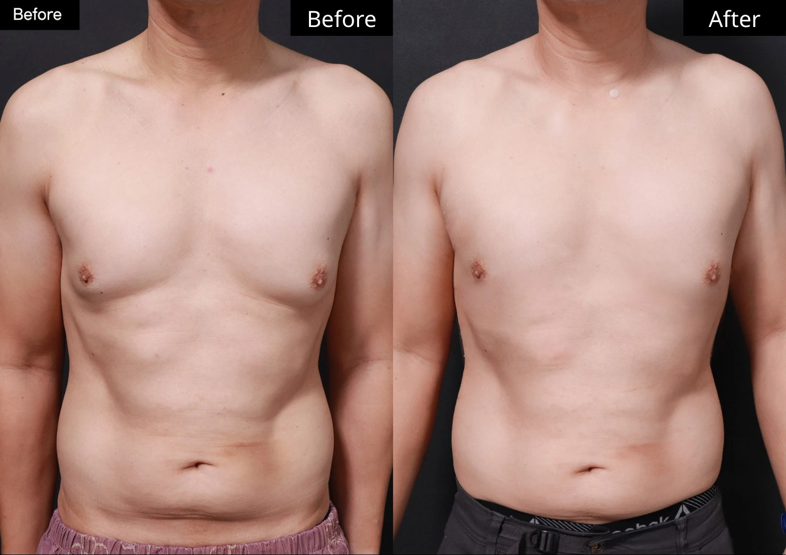 Verygood Plastic Surgery: Gynecomastia surgery — front view · 16. Before on the left; after on the right.