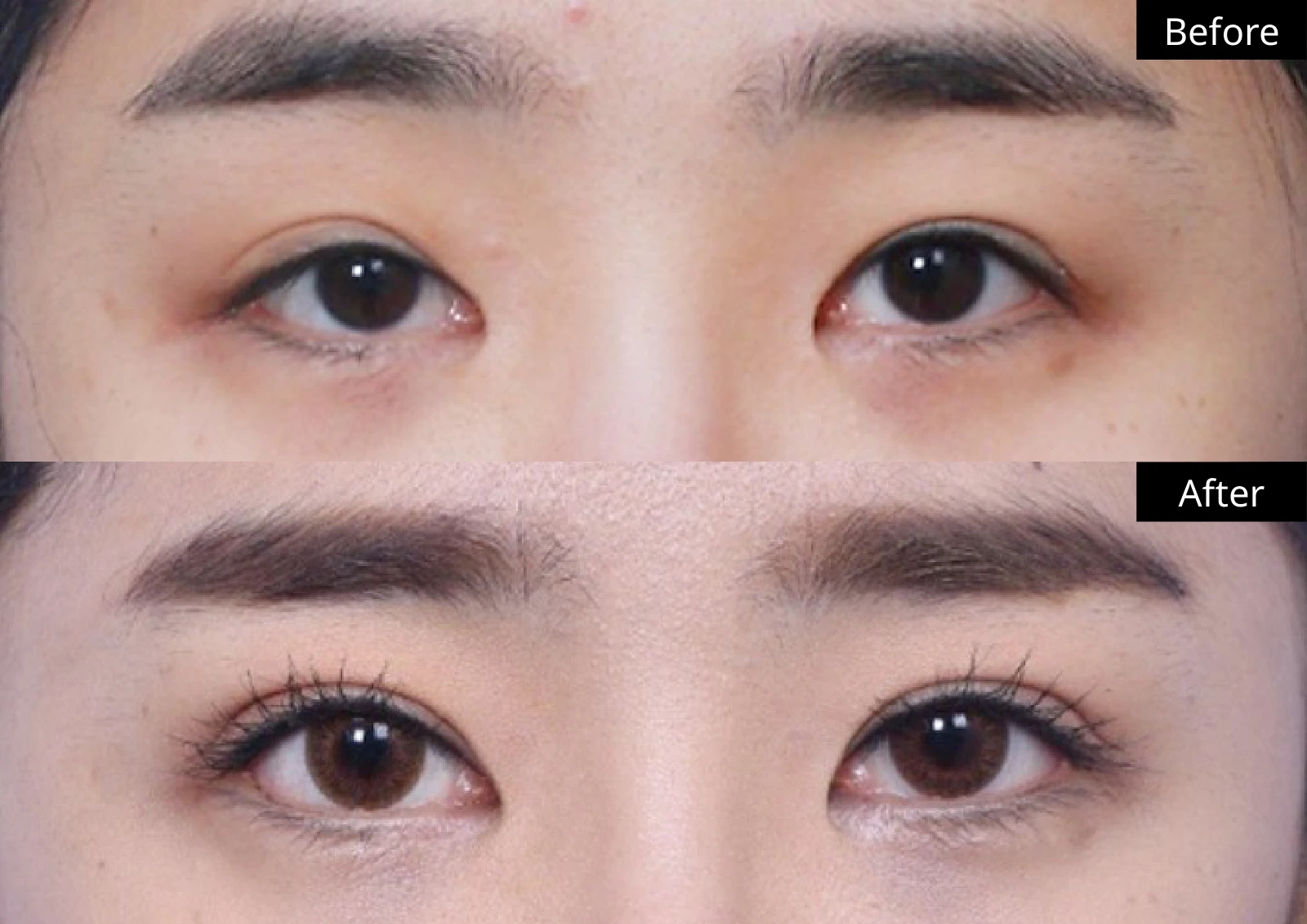 Verygood Plastic Surgery: Revision eyelid surgery — front view · 01. Before above; after below.
