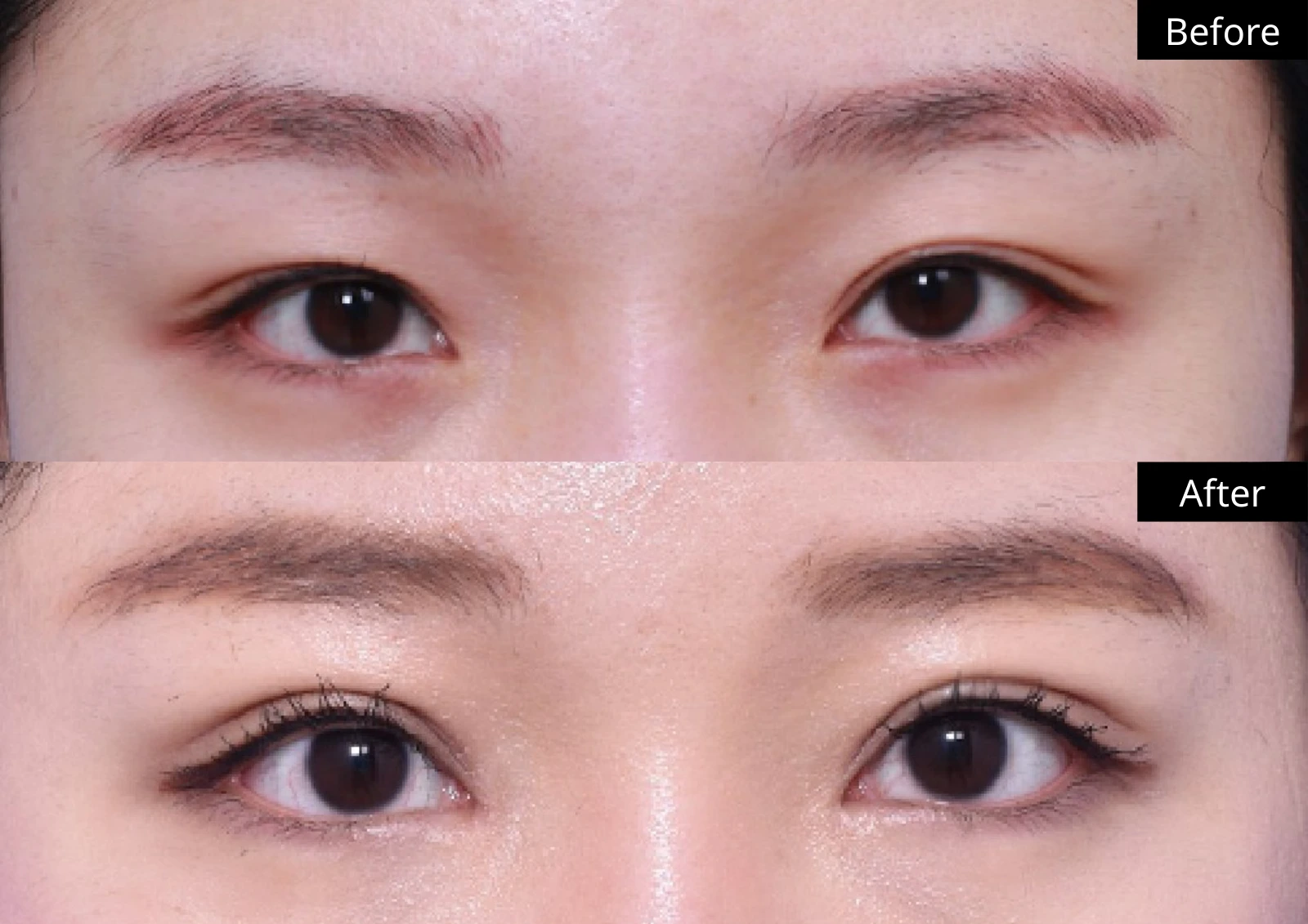 Verygood Plastic Surgery: Revision eyelid surgery — front view · 02. Before above; after below.