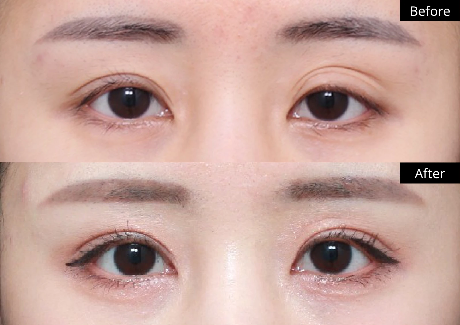 Verygood Plastic Surgery: Revision eyelid surgery — front view · 03. Before above; after below.