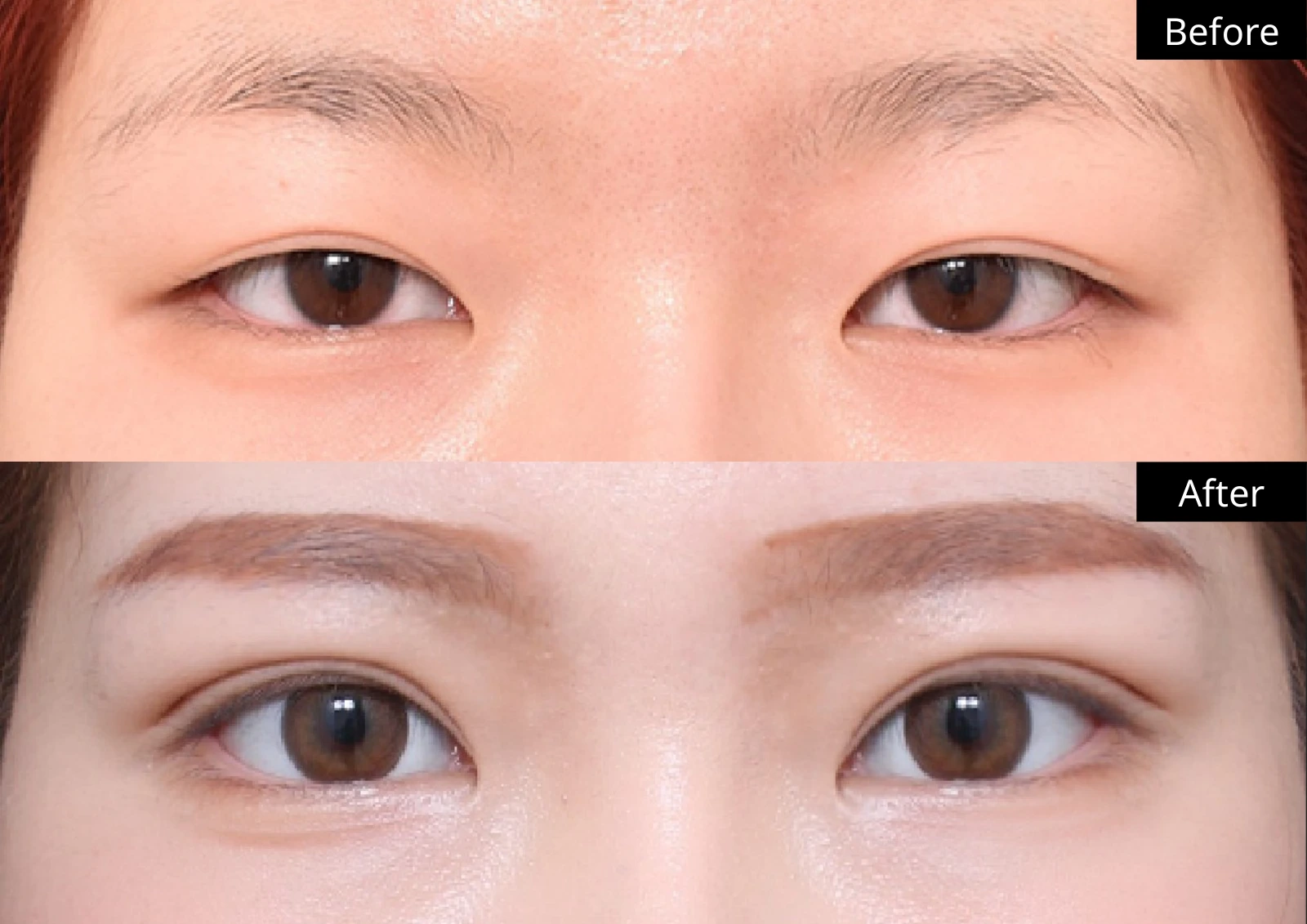 Verygood Plastic Surgery: Revision eyelid surgery — front view · 04. Before above; after below.