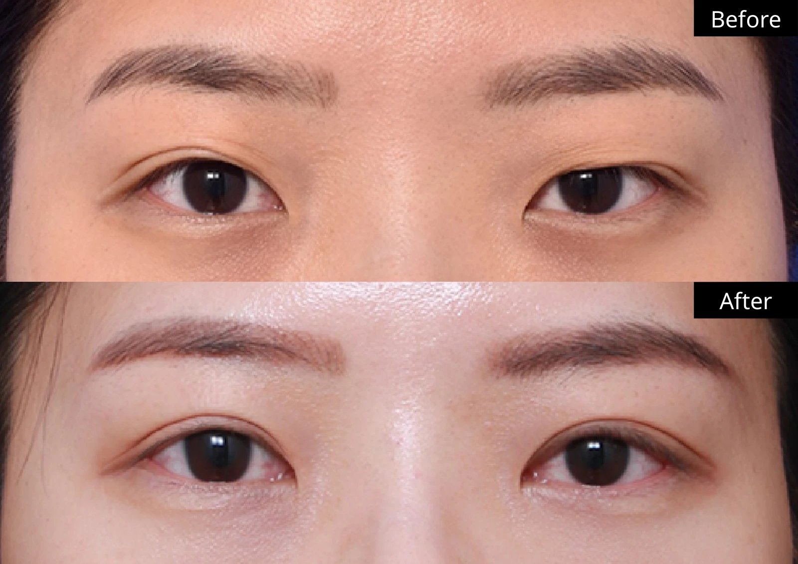 Verygood Plastic Surgery: Revision eyelid surgery — front view · 05. Before above; after below.