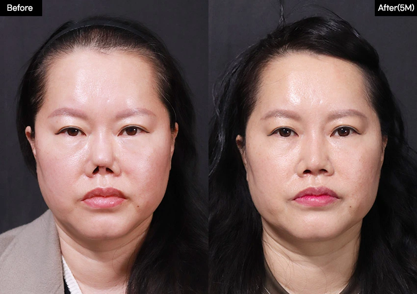 Verygood Plastic Surgery: Revision rhinoplasty — front view, 5 months · 19. Before on the left; after on the right.