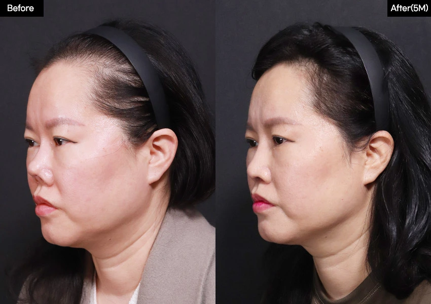 Verygood Plastic Surgery: Revision rhinoplasty — angled view, 5 months · 20. Before on the left; after on the right.