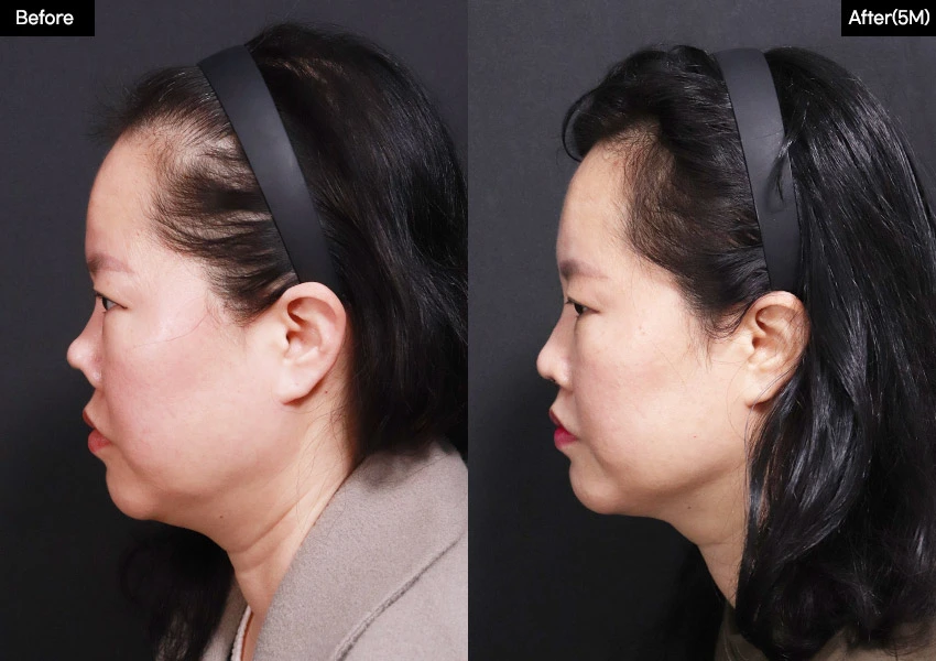 Verygood Plastic Surgery: Revision rhinoplasty — side profile, 5 months · 21. Before on the left; after on the right.
