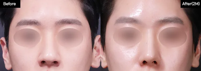 Rhinoplasty — front view, 2 months · 01 before and after at Verygood Plastic Surgery
