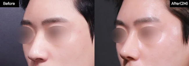 Rhinoplasty — angled view, 2 months · 02 before and after at Verygood Plastic Surgery