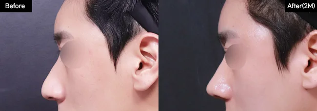 Rhinoplasty — side profile, 2 months · 03 before and after at Verygood Plastic Surgery