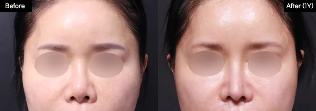 Rhinoplasty — front view, 1 year · 04 before and after at Verygood Plastic Surgery