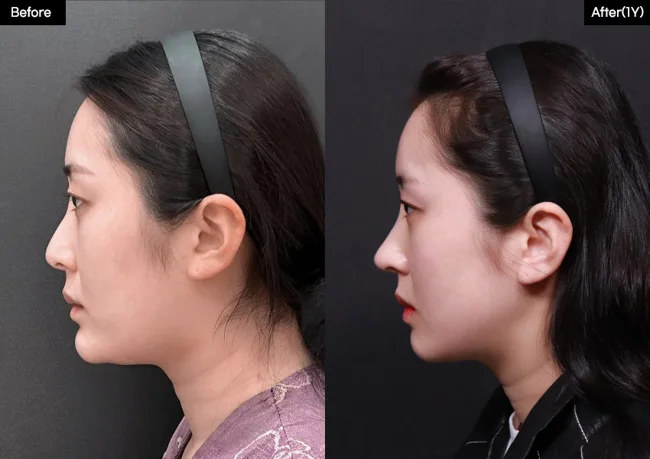 Rhinoplasty — side profile, 1 year · 25 before and after at Verygood Plastic Surgery