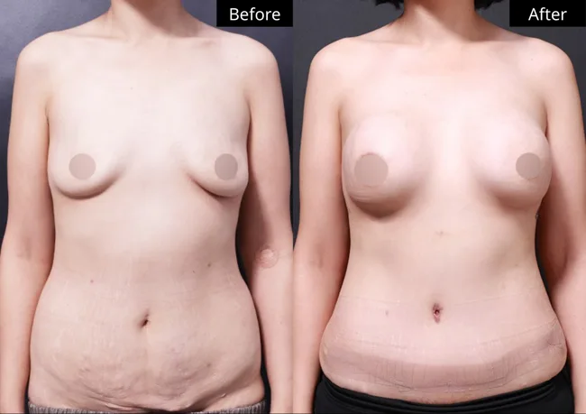 Tummy tuck — front view · 01 before and after at Verygood Plastic Surgery