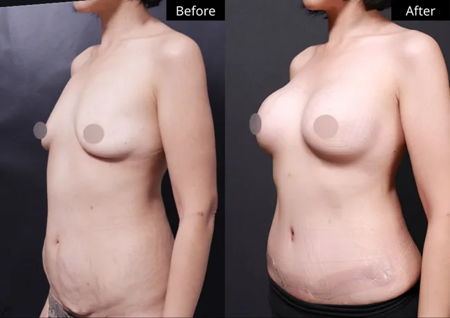 Tummy tuck — angled view · 02 before and after at Verygood Plastic Surgery