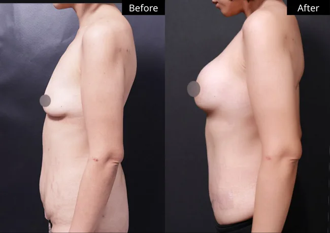 Tummy tuck — side profile · 03 before and after at Verygood Plastic Surgery