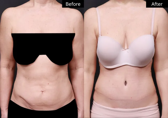 Tummy tuck — front view · 04 before and after at Verygood Plastic Surgery