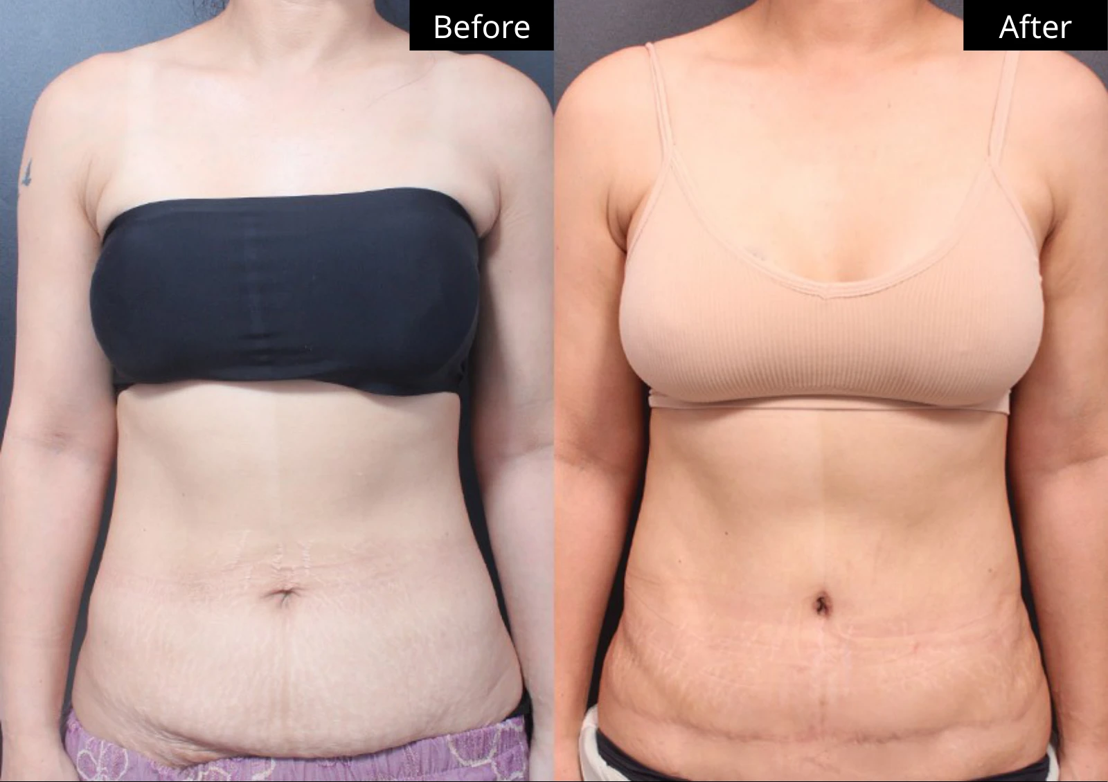 Verygood Plastic Surgery: Tummy tuck — front view · 13. Before on the left; after on the right.