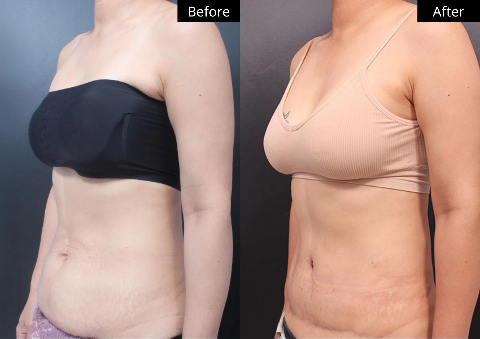 Verygood Plastic Surgery: Tummy tuck — angled view · 14. Before on the left; after on the right.