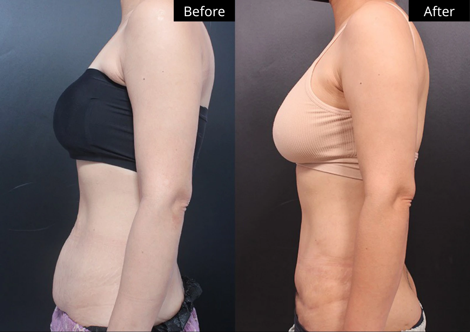 Verygood Plastic Surgery: Tummy tuck — side profile · 15. Before on the left; after on the right.