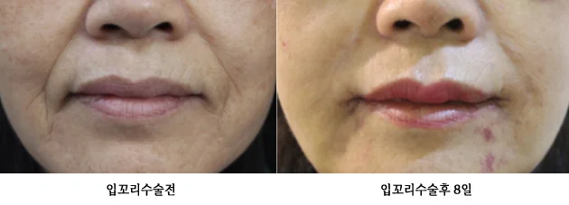 Mouth-corner surgery: eight-day follow-up at Yonsei Natural Beauty Aesthetic Surgical Clinic. Mouth-corner surgery: eight-day follow-up: before on the left and after on the right. The clinic’s source labels give the follow-up as 8 days.