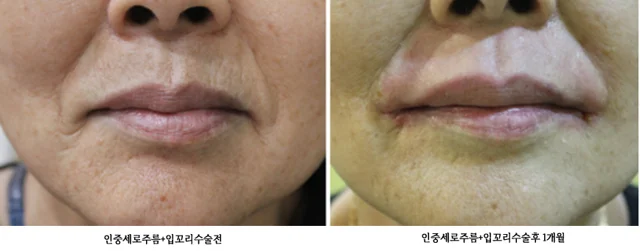 Upper-lip lines and mouth-corner surgery: one month at Yonsei Natural Beauty Aesthetic Surgical Clinic. Upper-lip lines and mouth-corner surgery: one month: before on the left and after on the right. The clinic’s source labels give the follow-up as 1 month.