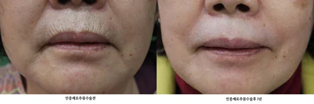 Vertical upper-lip lines: one-year comparison at Yonsei Natural Beauty Aesthetic Surgical Clinic. Vertical upper-lip lines: one-year comparison: before on the left and after on the right. The clinic’s source labels give the follow-up as 1 year.